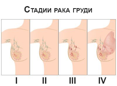 Рак Молочных Желез У Женщин Фото